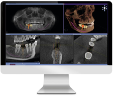 歯科インプラントシミュレーションシステム